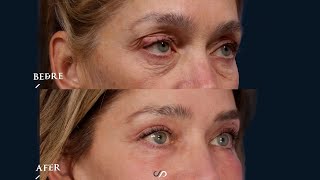 Eyelid Lift Surgery  CO2 Laser  Before and After  Dr David Stoker [upl. by Kristien]