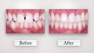 Clear Orthodontic Aligners [upl. by Akemot]