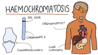 Understanding Haemochromatosis [upl. by Dat]