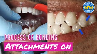 How Invisalign Attachments are placed [upl. by Kelula638]