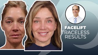 10 YEARS YOUNGER Traceless Facelift Surgery Before and After  Dr David Stoker [upl. by Eniahs]