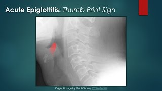 Acute Epiglottitis Thumb Sign [upl. by Enaerb956]