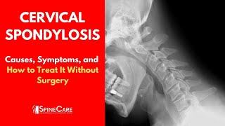 Cervical Spondylosis Causes Symptoms and Treatment [upl. by Eiramyelhsa]