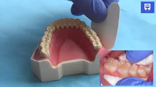 Technique for placing a resin fissure sealant [upl. by Loos]