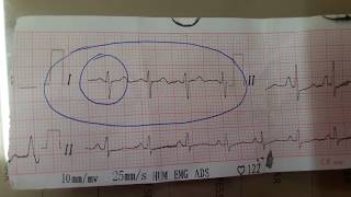 Cor Pulmonale ECG [upl. by Camella]