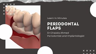 Periodontal Flaps [upl. by Llert853]