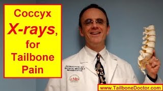 Coccyx Xrays for TAILBONE PAIN [upl. by Oznohpla]