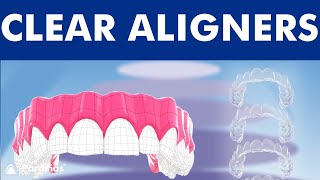 INVISALIGN  Orthodontic treatment with CLEAR ALIGNERS © [upl. by Alekahs]