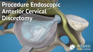 Cervical Spine Surgery [upl. by Demahom592]