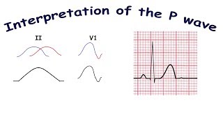 Interpretation of the P wave [upl. by Anglo]