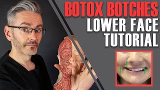 ADVANCED BOTOX ANATOMY How to avoid nasty lowerface side effects Aesthetics Mastery Show [upl. by Tibold]