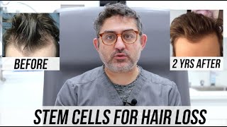 STEM CELL Hair Restorations 2 Year Updates Multiple Patient Success Stories [upl. by Soilissav]