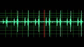 Pulmonary Associated Heart Sounds PAH Split S2 [upl. by Nohsyt141]