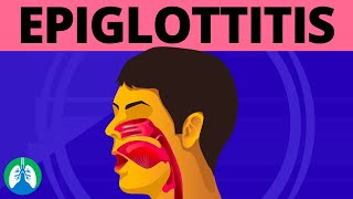 What is Epiglottitis Medical Definition [upl. by Saree254]