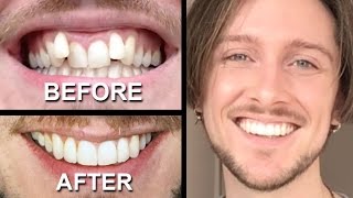 INVISALIGN REVIEW  everything you need to know [upl. by Nylirret]