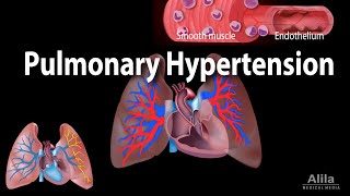 Pulmonary Hypertension Animation [upl. by Gerhardt556]