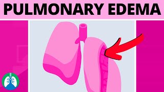 Pulmonary Edema Medical Definition  Quick Explainer Video [upl. by Eydie]