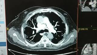 CT PULMONARY ANGIOGRAPHY [upl. by Jacoby659]