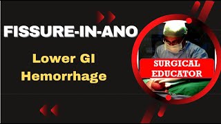 FISSURE IN ANO How To DIAGNOSE amp TREAT Lower GI Hemorrhage [upl. by Dnamra]