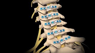 Cervical Total Disc Replacement [upl. by Casia]