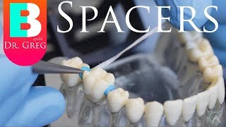 BRACES EXPLAINED Spacers [upl. by Scevour]