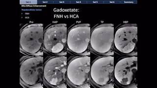 CT Differential Diagnosis of Focal Hepatic Lesions Basic Radiology [upl. by Chouest979]