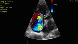 Echocardiogram Cor Pulmonale PHTN Pulmonary Hypertension [upl. by Nutsud]