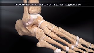 InternalBrace™ ATFL Talus to Fibula Ligament Augmentation [upl. by Calista]