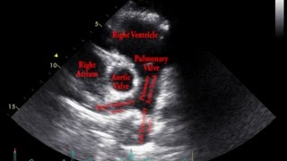 Echocardiogram Parasternal Short Axis View Pulmonary Arteries  Loop [upl. by Esinart270]