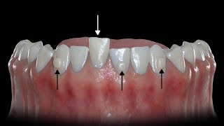 How Buttons Help Clear Aligners [upl. by Notelrac]