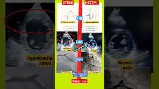 Difference between STEMI  Heart attack💔 and NSTEMI by ECG ECHO ANGIOGRAPHY echo shorts [upl. by Nnuahs]