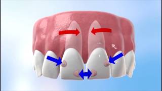 Discover how Invisalign works [upl. by Jillene]