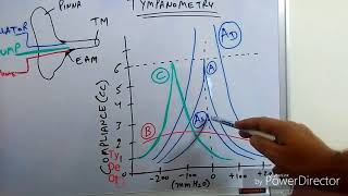 Tympanometry Impedance Audiometry [upl. by Iridissa]