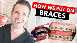 How Braces are Put On  Part IV Dr Nate [upl. by Namruht963]