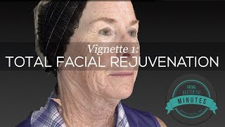 69 yo Female Total Facial Rejuvenation  An Amazing Transformation  Aesthetic Minutes Facelift [upl. by Tnafni]