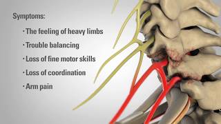 CERVICAL SPONDYLOSIS Causes Symptoms and Treatment NO SURGERY [upl. by Ocire523]