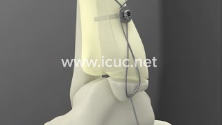 Medial Malleolus ORIF  ICUC® Video [upl. by Janene]