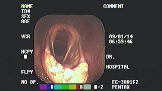 Epiglottic Entrapment [upl. by Layap587]