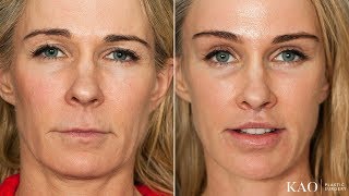 Facelift Before amp After  Ponytail Lift™  Upper Lip Lift  Kao Plastic Surgery  Mommy Makeover [upl. by Elisabeth771]