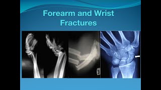 Forearm and Wrist fractures [upl. by Stout]