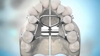 Surgically Assisted Palatal Expansion [upl. by Ruy]