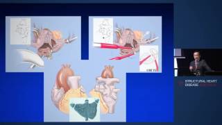 Surgical Pulmonary Vein IsolationMAZE  Dr Michael Yii [upl. by Enotna984]