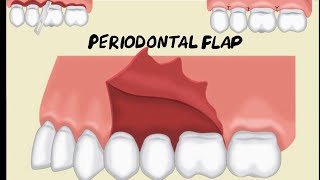 Periodontal Flap [upl. by Nylhtak375]