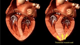 Hypertrophic Cardiomyopathy [upl. by Schechinger]