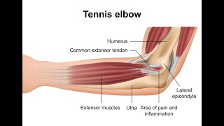 Tennis Elbow Cant Wait [upl. by Cora]