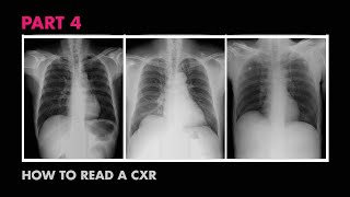 Assessment of CXR Positioning amp Views  How to Read a Chest XRay Part 4  MEDZCOOL [upl. by Assirehc]