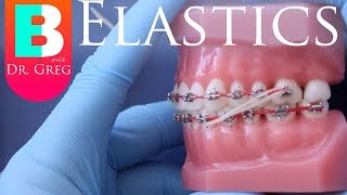 BRACES EXPLAINED Elastics  Rubber Bands [upl. by Ynohtnacram]