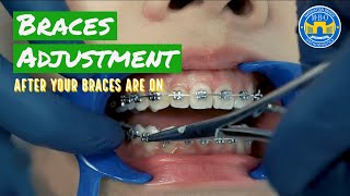 How Do Braces Straighten Teeth [upl. by Siramay461]