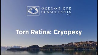 Retinal Tear Cryopexy [upl. by Drofdarb]