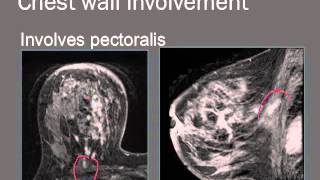 Breast MRI interpretation [upl. by Hoban]